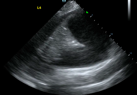 Pleural effusion at the left lung base