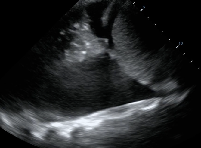 Large pleural effusion with consolidated lung