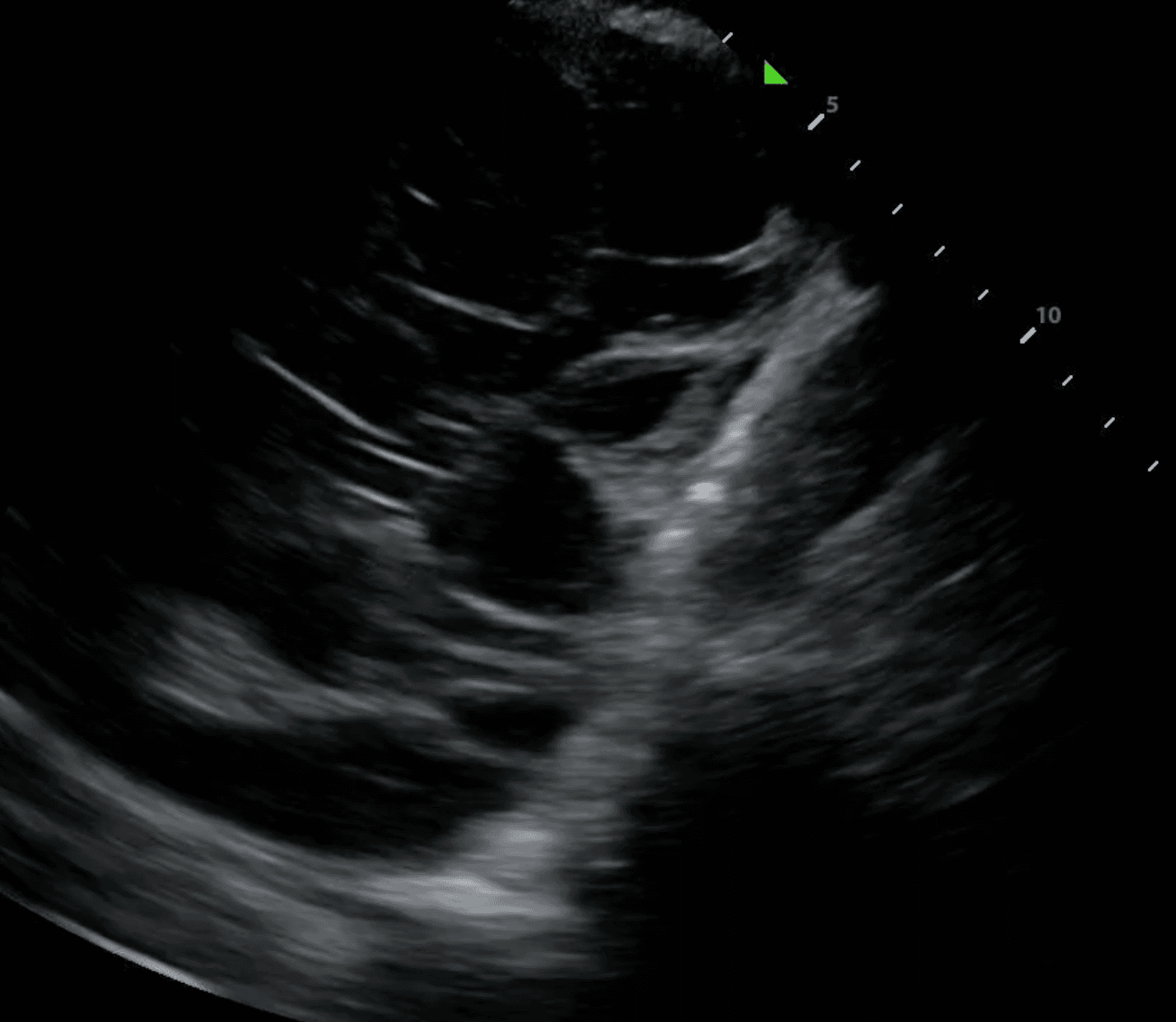 Septated pleural effusion