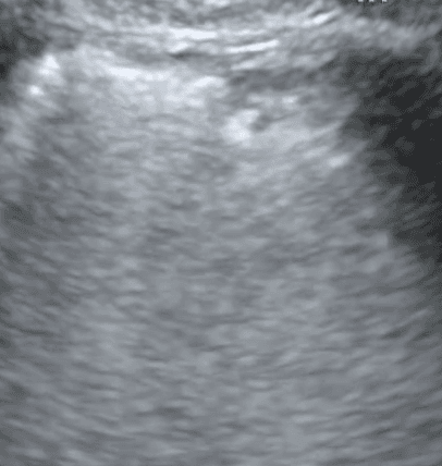 Image of a thick, irregular pleural line