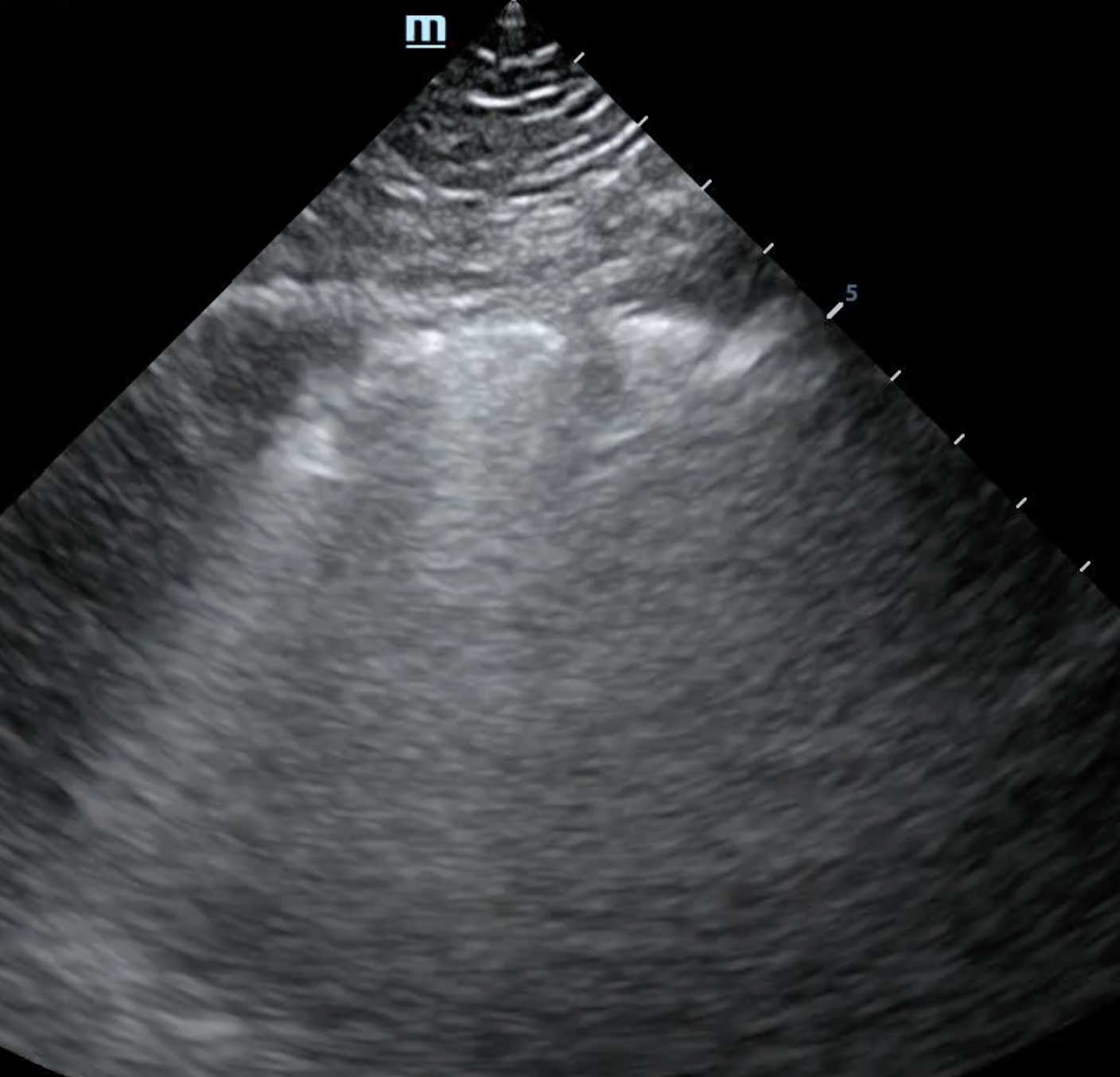 Subpleural consolidation