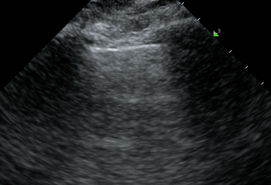 Bright pleural line in the middle of the image, flanked by dark rib shadows on each side.