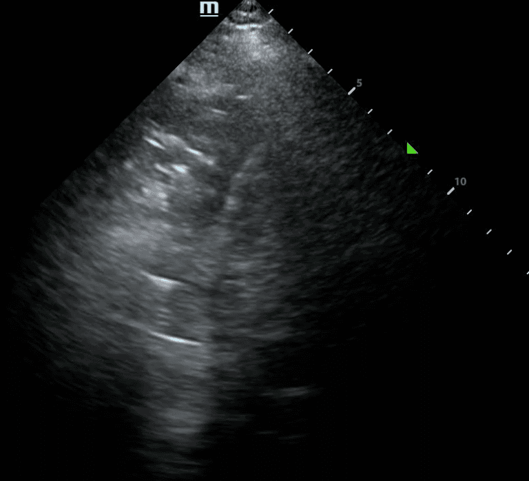 Image of a static air bronchogram