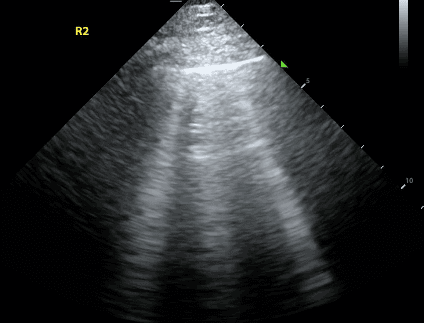 Lung ultrasound scan