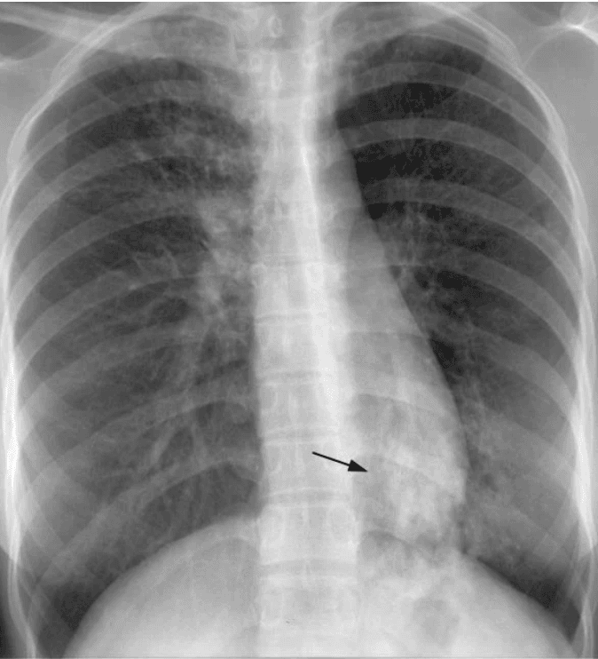 Chest X-ray demonstrating subtle tuberculosis