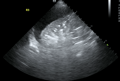 Image of lung consolidation