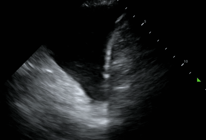 Large pleural effusion