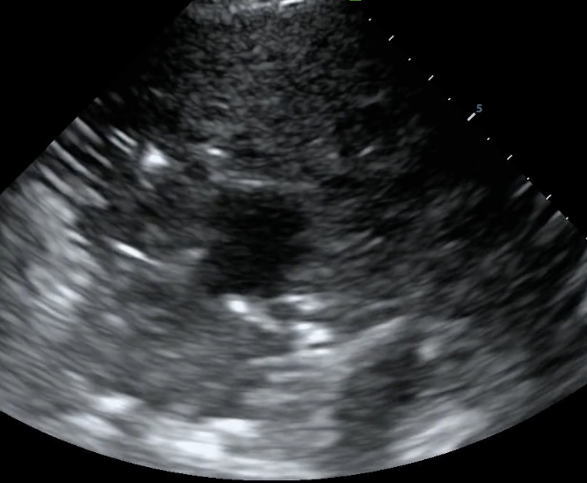 Shred sign separating subpleural consolidation from normal lung