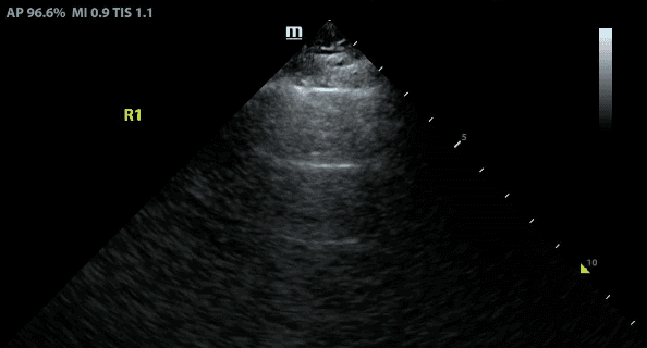Normal A line lung ultrasound pattern